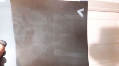 Щелчок в тазобедренном суставе у грудничка