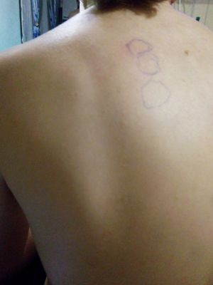 Болит около лопатки
