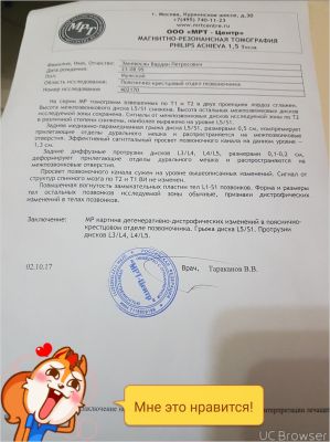 Циркулярная протрузия диска l3 l4