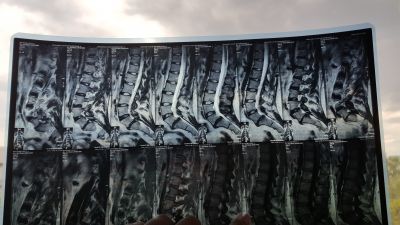 Дорзальная протрузия