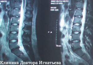 Коррекция позвоночника
