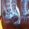 Грыжи межпозвонковых дисков оклюзия бедренной артерии
