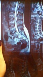 Межпозвонковая грыжа лечение