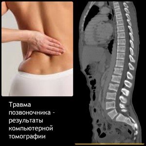 Спондилолистез шейных позвонков релбилиьация зарядка