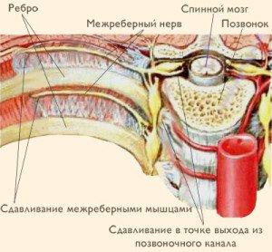 Что будет если запустить межреберную невралгию?