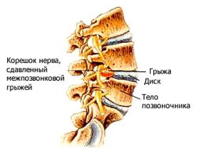 Боли в стопе при ходьбе лечение