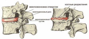 Позвоночник имеются массивные краевые остео