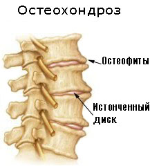 Остеохондроз пояснично крестцового