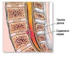 Грыжа межпозвоночного диска лечение