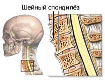 Спондилез шейный лечение
