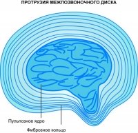 Причины протрузии дисков