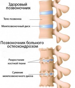 Остеохондроз поясницы лечение