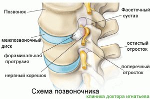 Протрузия межпозвонкового диска Протрузия диска l4 l5