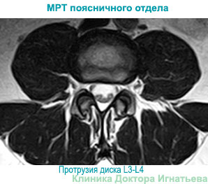Спондилоартроз l3 s1