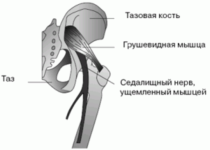 Болит седалищный нерв что делать