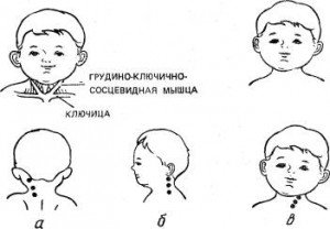 Массаж при кривошее у Грудничков