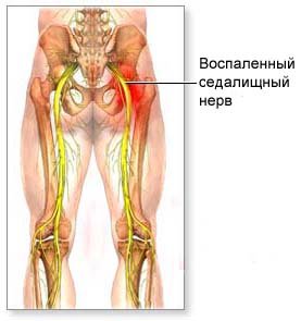 Седалищный нерв лечение