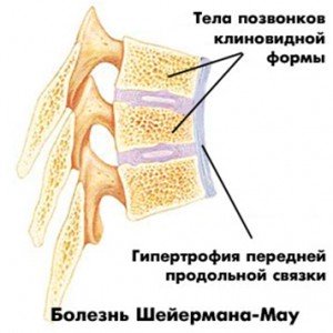 Болезнь шейермана мау