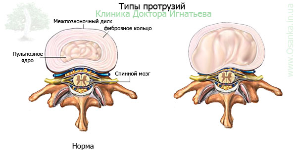 Фораминальная грыжа